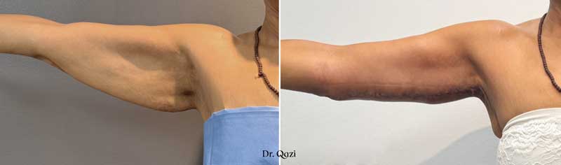 armlift by Dr Qazi before and after